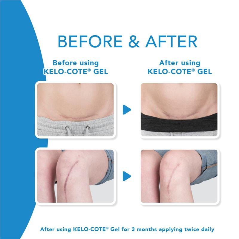 Kelo-Cote Scar Treatment Gel 6g